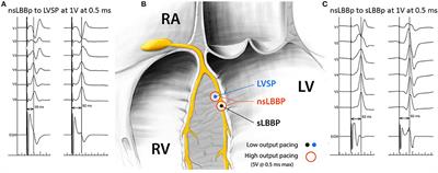 Left Ventricular Myocardial Septal Pacing in Close Proximity to LBB Does Not Prolong the Duration of the Left Ventricular Lateral Wall Depolarization Compared to LBB Pacing